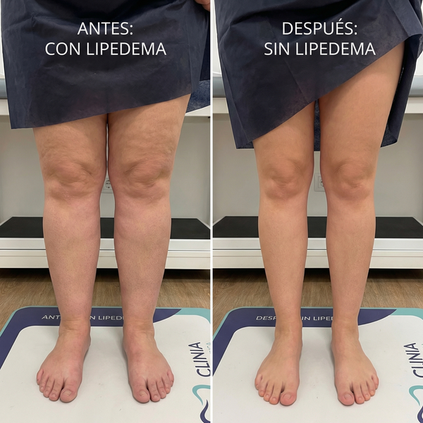 💧 Lipedema